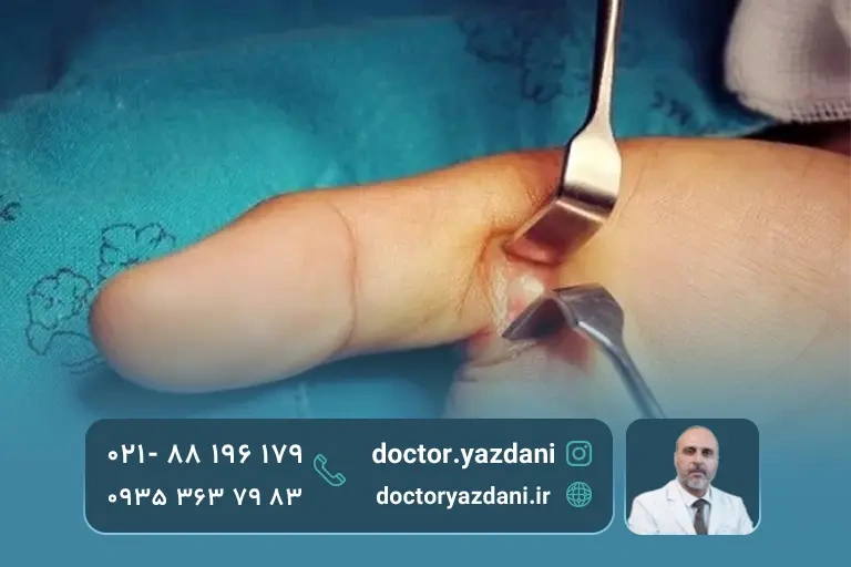 درمان تریگر فینگر