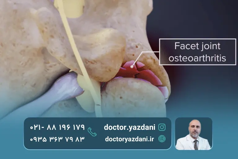 مراحل بروز عارضه گردن رو به جلو