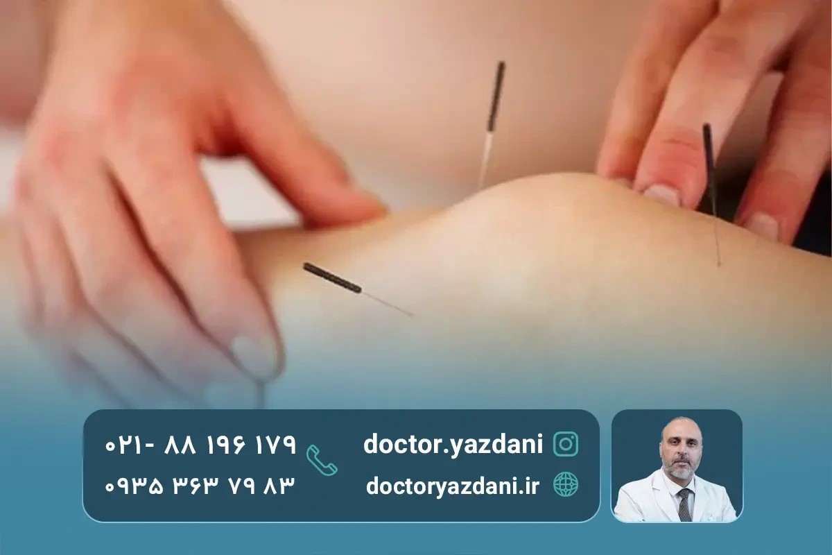 مزایای طب سوزنی در پارگی مینیسک زانو