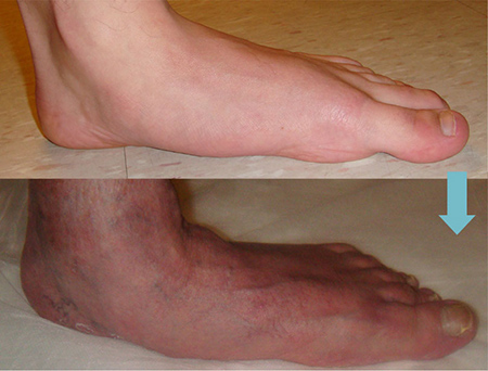 درمان چرخش مچ پا به داخل درمان پای کج در بزرگسالان