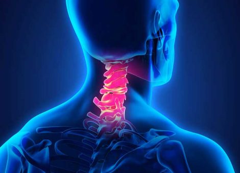درمان دیسک گردن و گردن درد: سوالات متداول