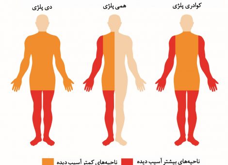 درمان فلج مغزی در بزرگسالان و کودکان: اسپاستیک و همی پارزی