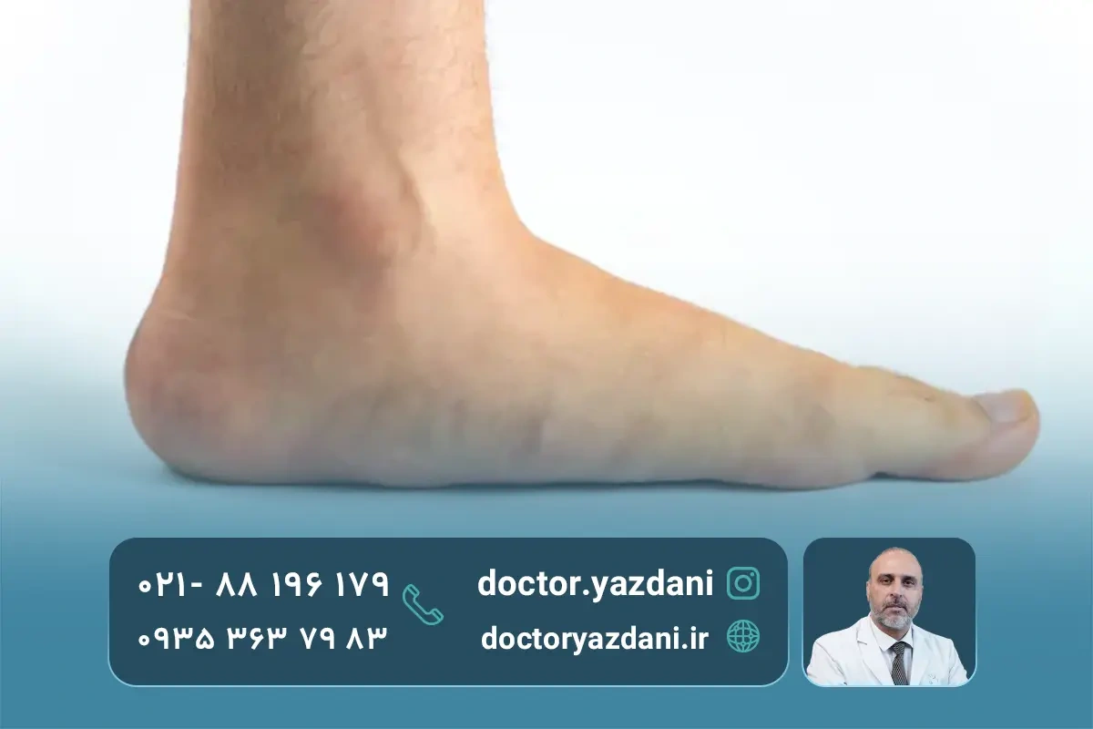 مهم‌ ترین دلایل صافی کف پا