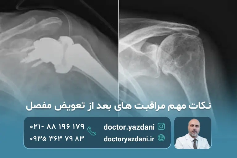 پروتز شانه