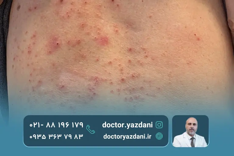 واکنش پوستی به پد های الکترونیکی