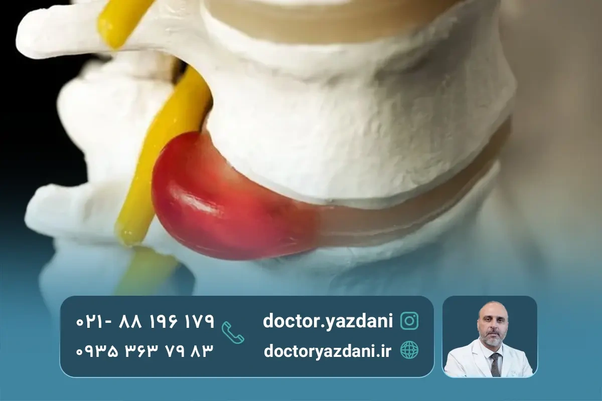 پارگی دیسک کمر در چه افرادی شایع‌ تر است؟