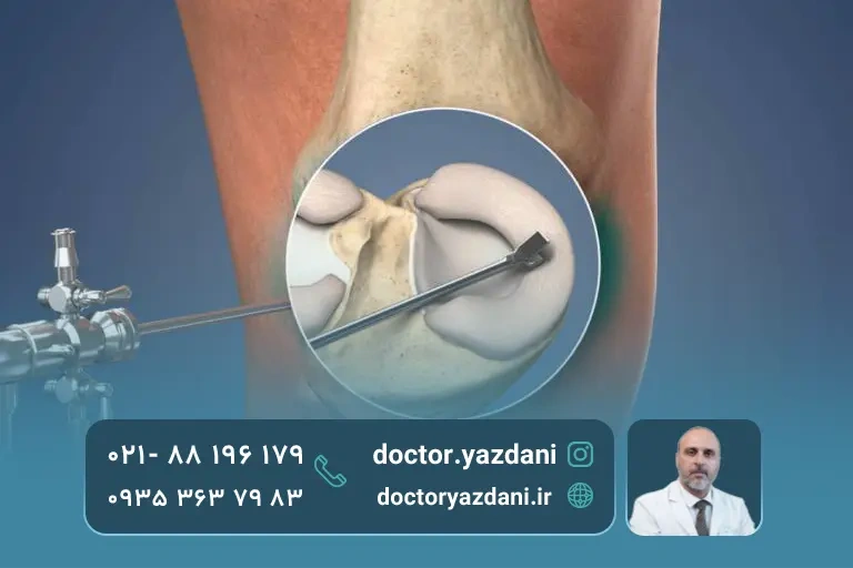 عکس پارگی مینیسک زانو