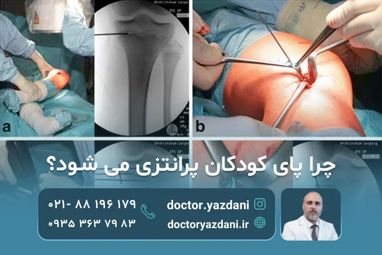 درمان پای پرانتزی در کودکان