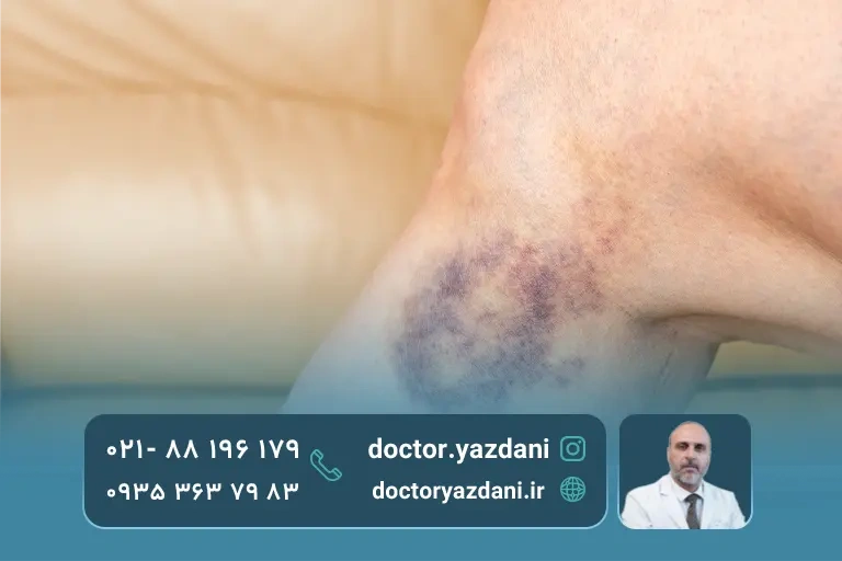 کبودی جزئی در نواحی تحت درمان